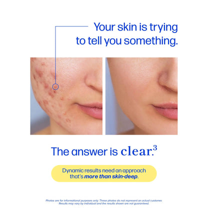Clear Skin Acne Supplement with Zinc, DIM & Probiotics | 3-in-1 Balance, Clarify, Restore Support with Hyaluronic Acid & Skin Support Vitamins | For Women & Men | Oral Hormonal Acne Pills